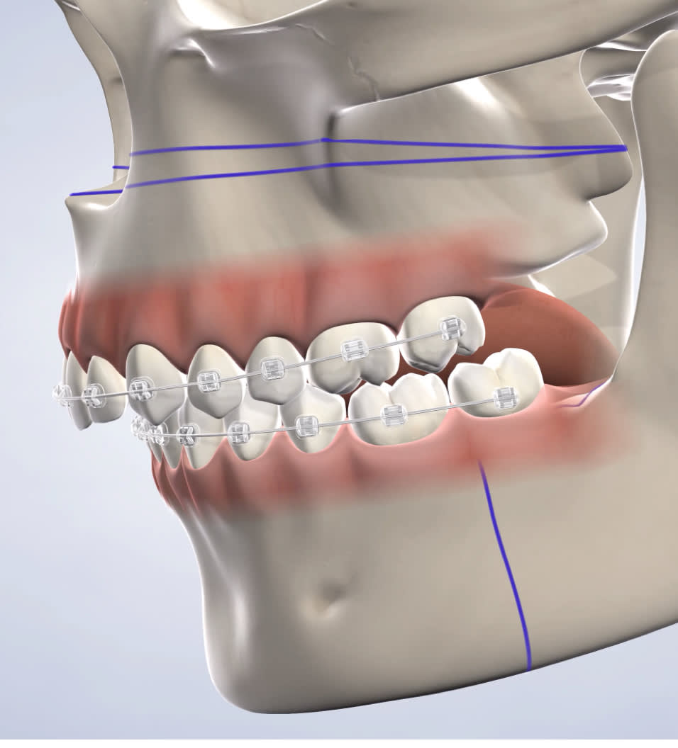 Jaw surgery procedure query page