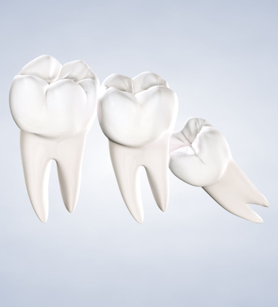 Wisdom teeth removal procedure query page