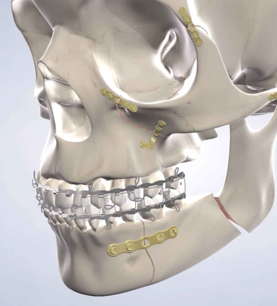 Illustration of a human skull with surgical metal plates and screws attached to the jaw and cheekbones.