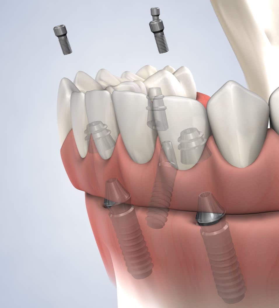 Illustration of dental implants being placed in the jawbone to support artificial teeth.