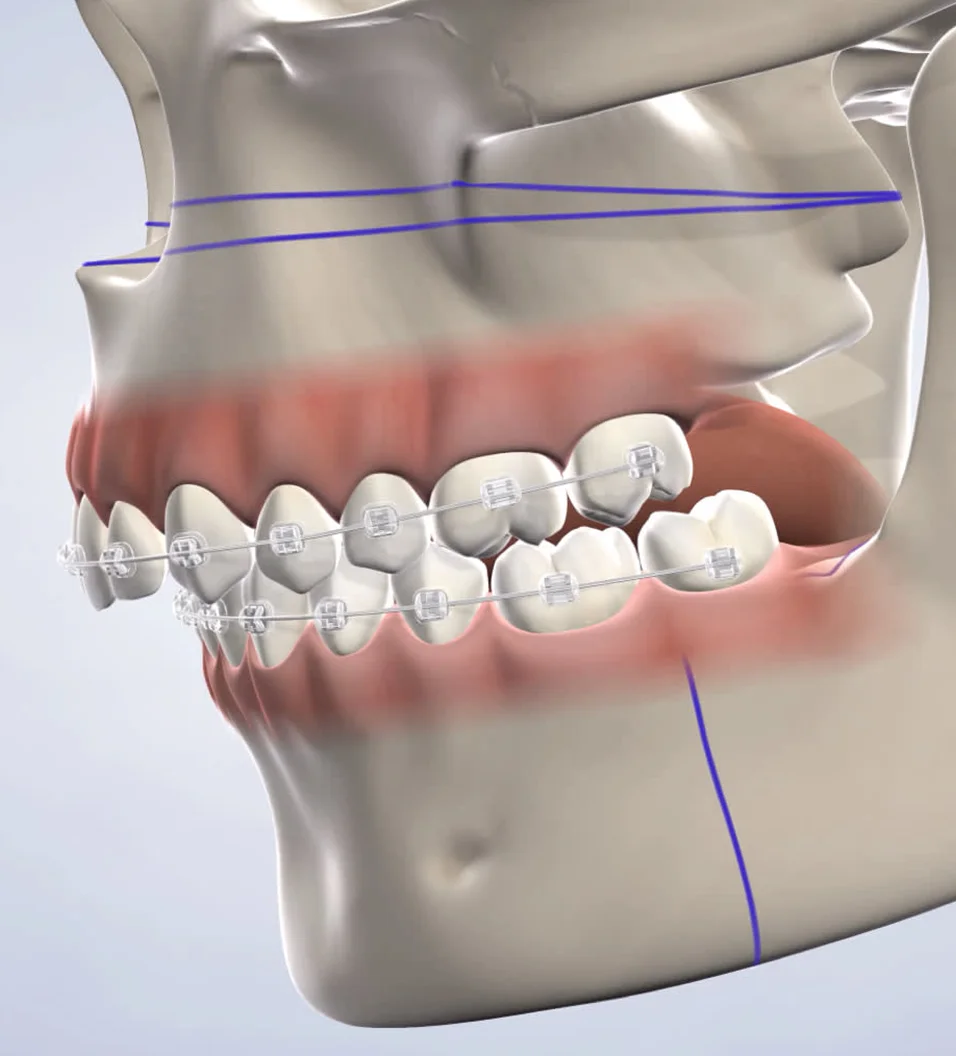 3D rendering of a human jaw with braces, showcasing the alignment of teeth and gums.