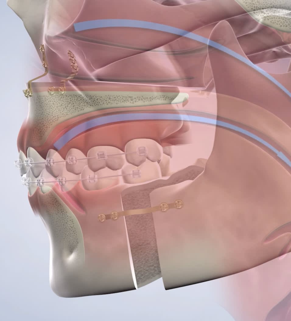 Side view illustration of human jaw with braces, showing teeth alignment and jaw structure.