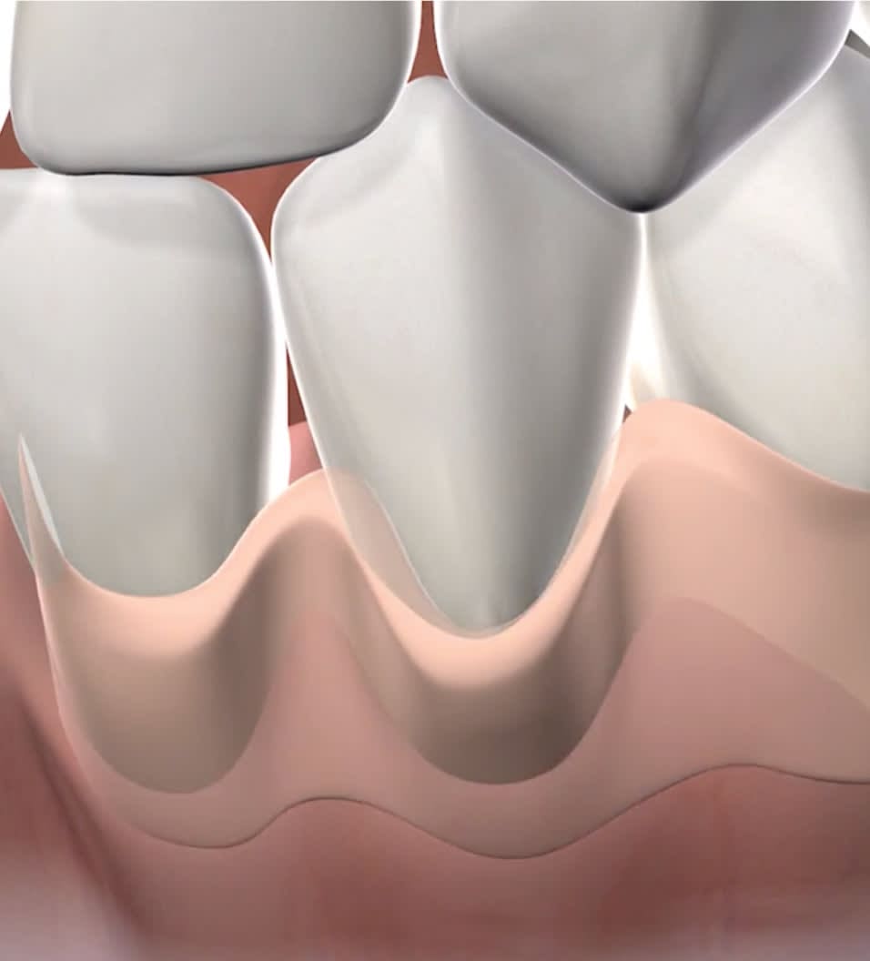 Digital rendering of human teeth and gums highlighting bone loss, showing exaggerated gum recession and exposure of tooth roots.