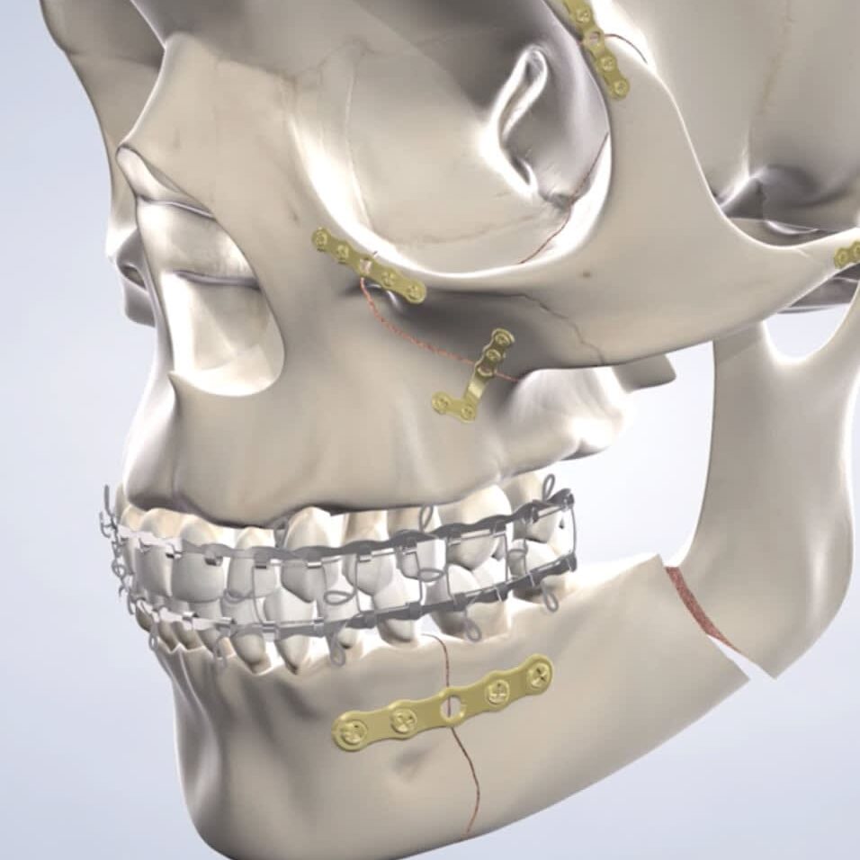 3D model of a human skull with braces.