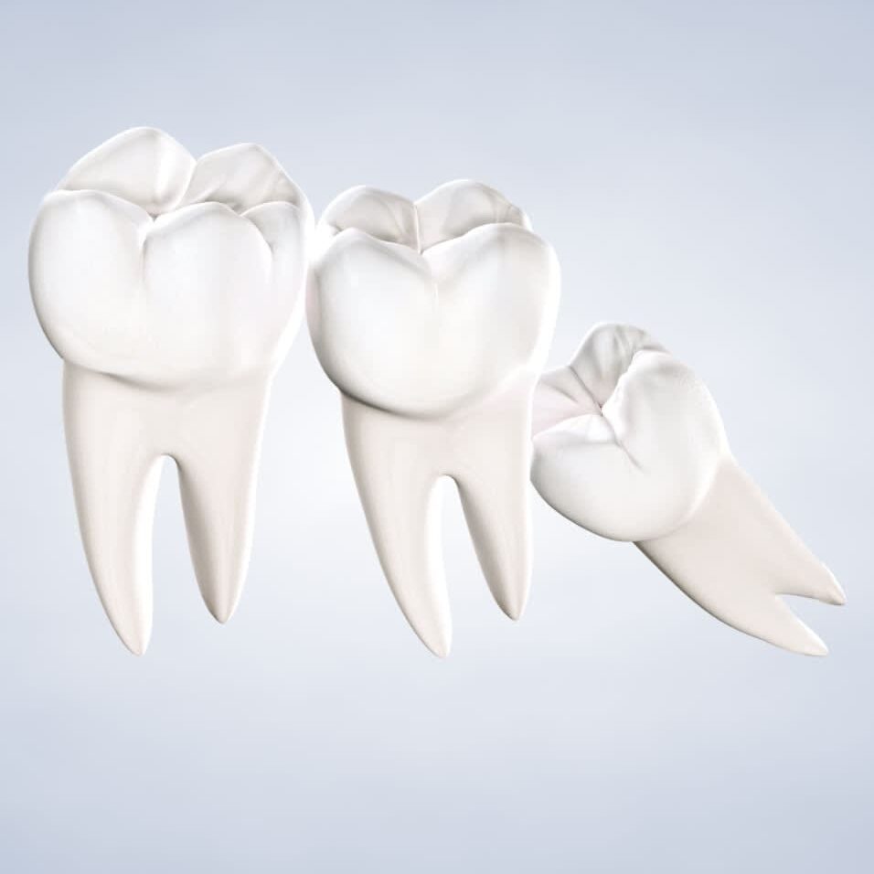 wisdom-teeth-removal-procedure-query-page